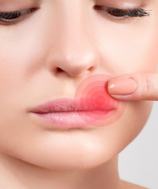 Lippenherpes ist gefährlich, wenn das Immunsystem geschwächt ist