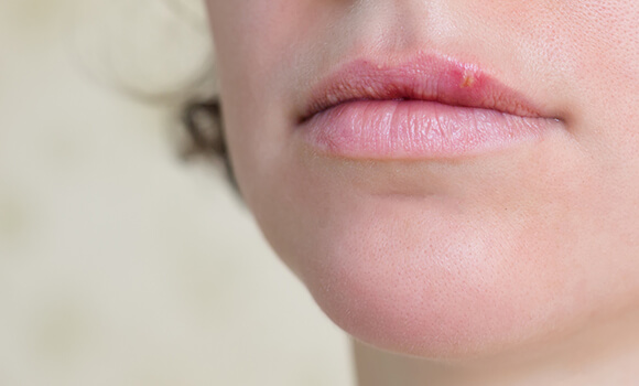 Mundbereich mit positivem Lippenherpes-Verlauf