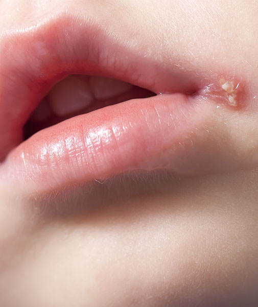 Beim Herpes bei Kindern können sich kleine Bläschen an der Lippe bilden.